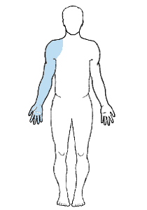 Schematische Darstellung: Armplexusanästhesie