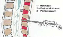 Periduralanästhesie