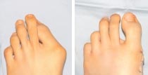 Ausgeprägter Hallux valgus und Korrekturergebnis