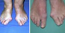 Hallux valgus Deformität