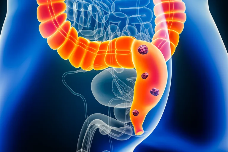 Ein Rektumtumor (Rektumkarzinom oder Analkrebs) wird auch Mastdarmkrebs genannt und ist ein bösartiger Tumor, der den unteren Teil des Dickdarms betrifft.