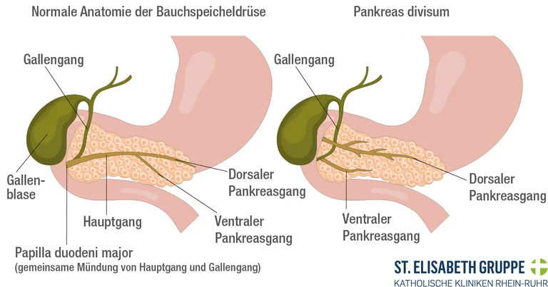 Abgebildet ist eine Bauchspeicheldrüse. Pankreas divisum gehört zu den häufigsten anatomischen Veränderungen der Bauchspeicheldrüse.