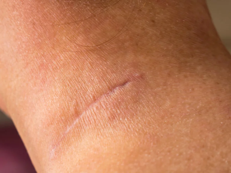 Nach der Entfernung eines Tumors entstehen oft Narben