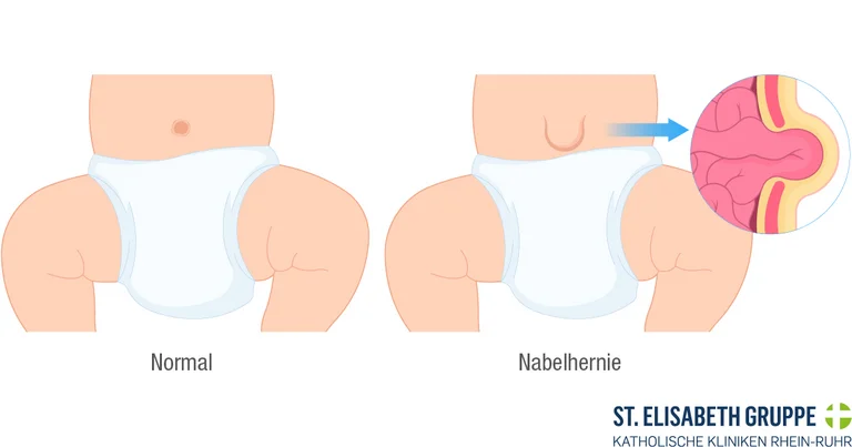 Nabelhernie