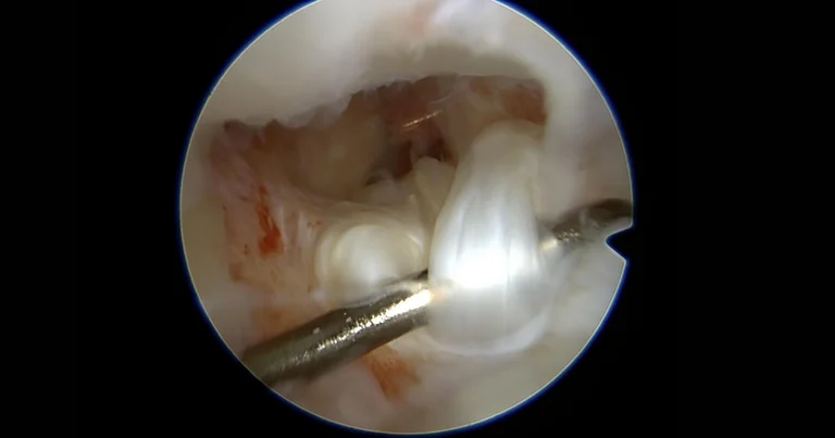 Bildschirmansicht einer Arthroskopie des Handgelenks