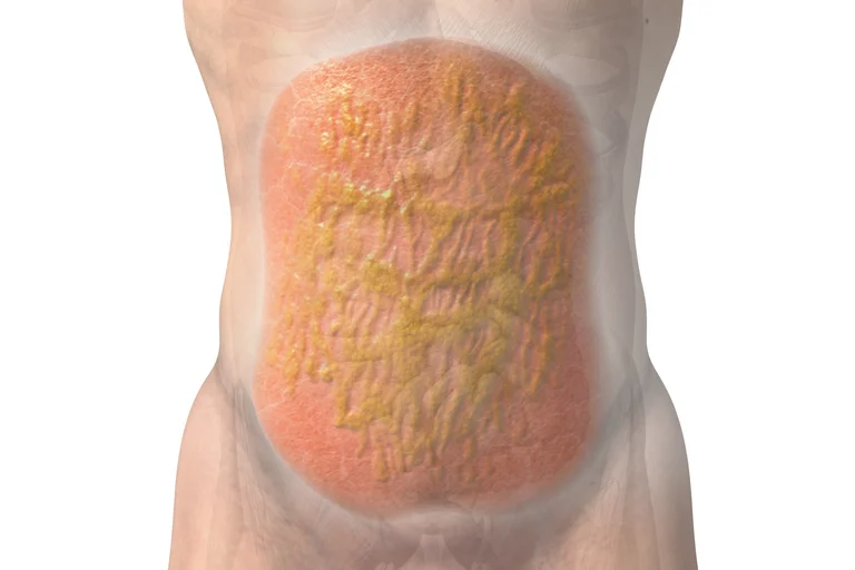 Eine Bauchfellentzündung (Peritonitis) eine durch Infektionen, nach einer Verletzung der Bauchdecke oder der inneren Organe hervorgerufenen Erkrankung. 