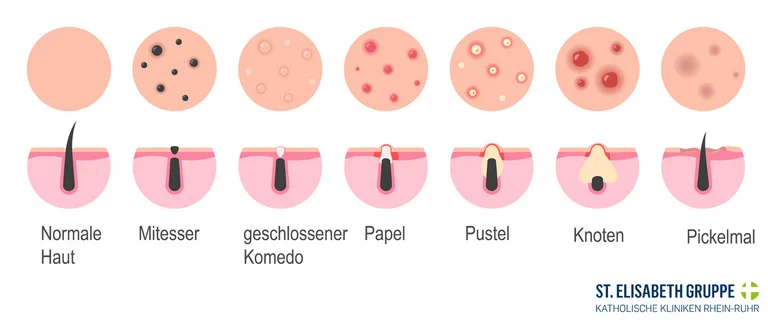 Grafiken mit verschiedenen Akne-Symptomen