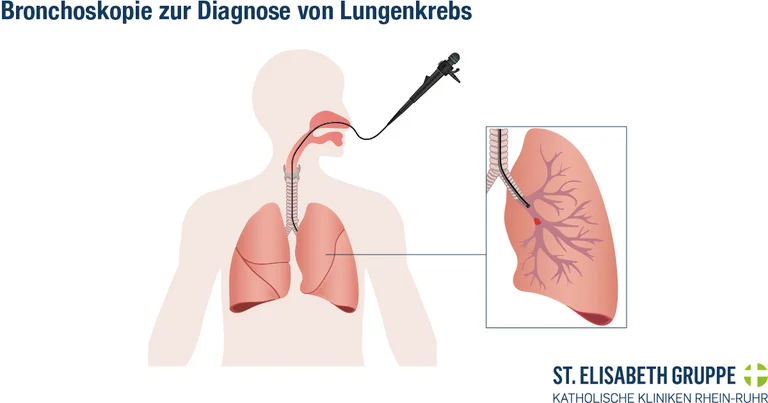 Darstellung einer Bronchoskopie beim Menschen