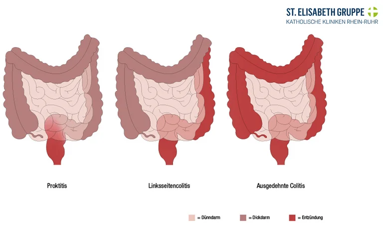 Bei einer Colitis ulcerosa werden verschiedene Schweregrade unterschieden.