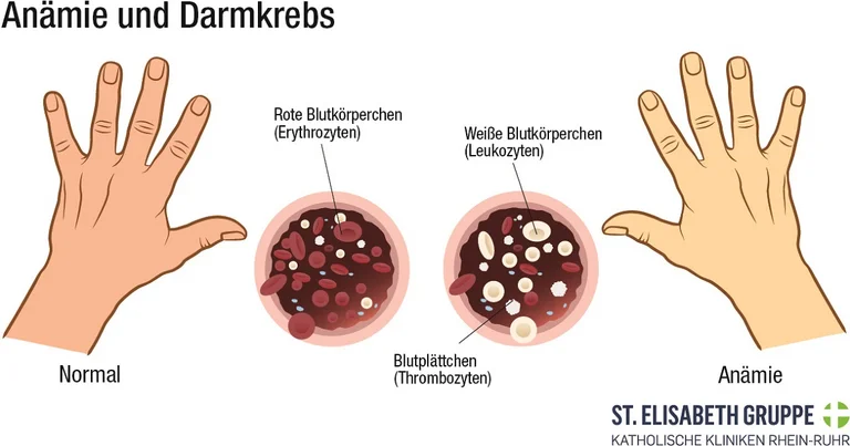 Blutarmut (Anämie) durch einen chronischen, unbemerkten Blutverlust, kann ein Anzeichen für Darmkrebs sein.