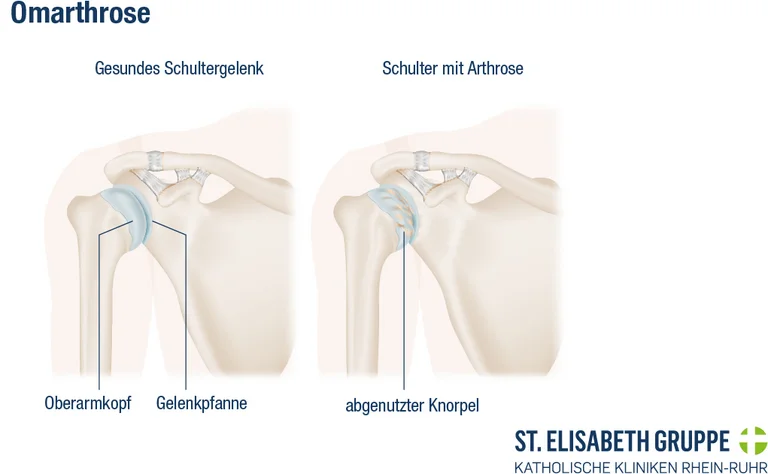 Grafik einer gesunden Schulter im Vergleich zu einer Schulter mit Omarthrose