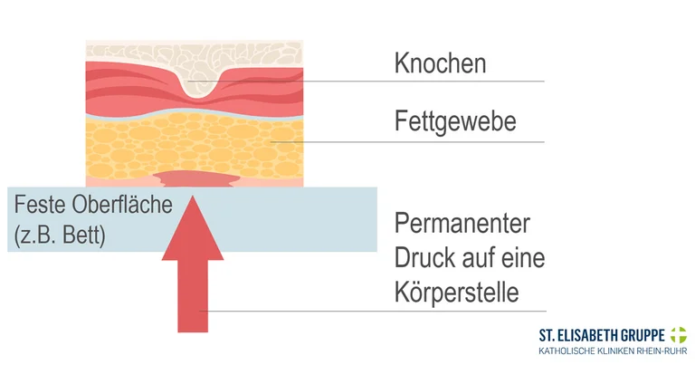 ein Dekubitus entsteht durch permanenten Druck auf eine bestimmte Körperstelle