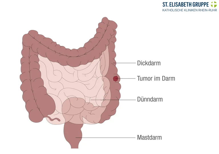 Darmkrebs kann als Dickdarmkrebs, Dünndarmkrebs oder Enddarm-/Mastdarmkrebs auftreten.