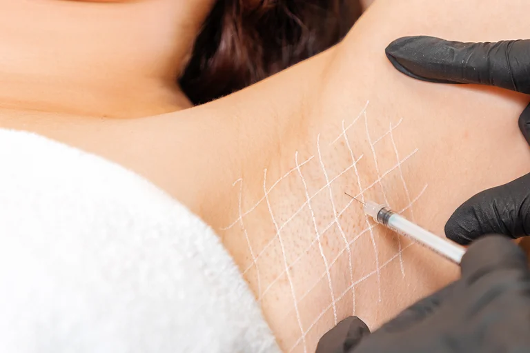 Botox-Injektion im Achselbereich einer Frau zur Bekämpfung der Hyperhidrose