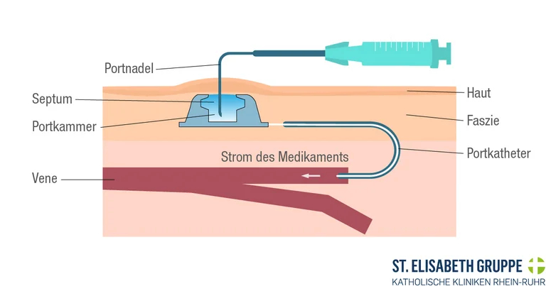 Grafische Darstellung eines Portsystems: Portnadel, Septum, Portkammer und Katheter zeigen den Weg des Medikaments in das venöse Blutgefäß.