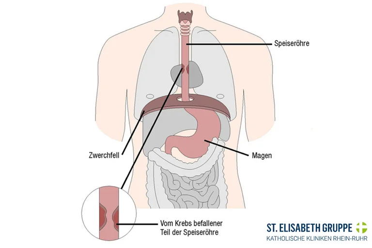Schematische Darstellung von Speiseröhrenkrebs und einer Speiseröhre, die von Krebs befallen ist.