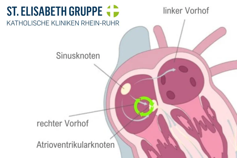 Grafische Darstellung der AVNRT
