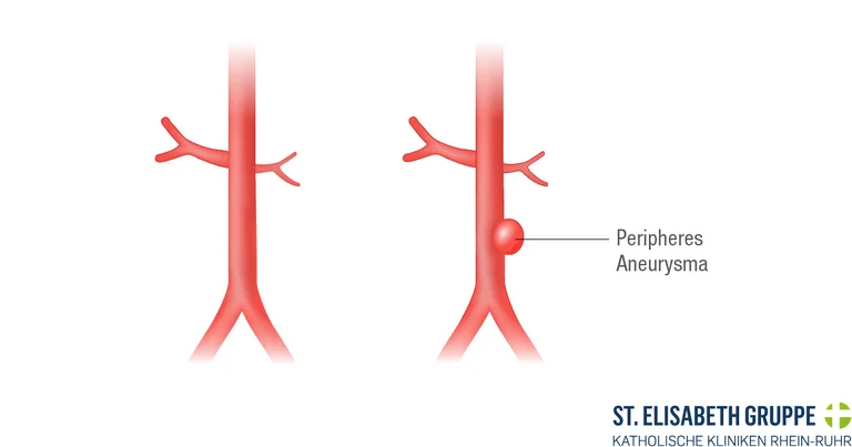Medizinische Grafik zeigt den Unterschied zwischen einem gesunden Blutgefäß und einem peripheren Aneurysma mit Thrombenbildung.
