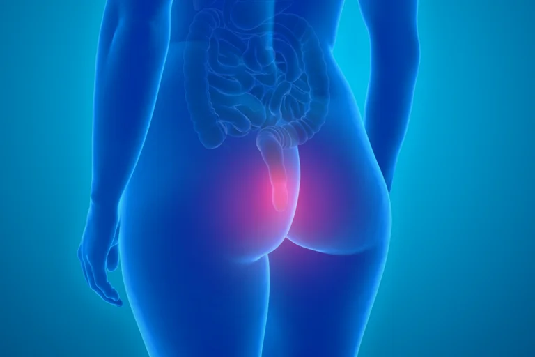 Hämorrhoiden bereiten dann Probleme, wenn sie sich vergrößern und Symptome wie Jucken oder Blutungen auftreten.