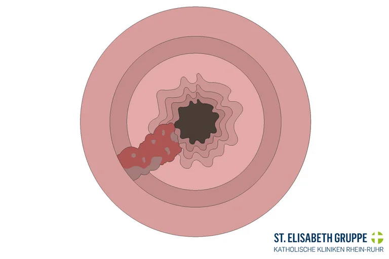 Grafik: Endoskopiebild einer Speiseröhre, die von Krebs befallen ist.
