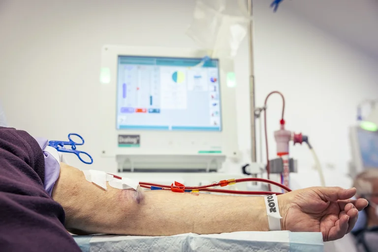 Patient mit einem Shunt bei der Hämodialyse