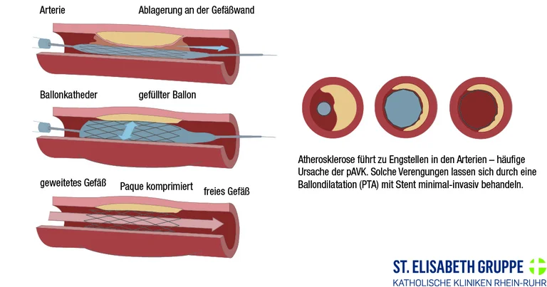 Grafische Darstellung einer Arterie mit atherosklerotischer Plaque aus Fetten, Kalzium und Zellresten, die das Gefäß verengt – typisches Zielgebiet für eine Ballonaufdehnung mit Stent bei pAVK.