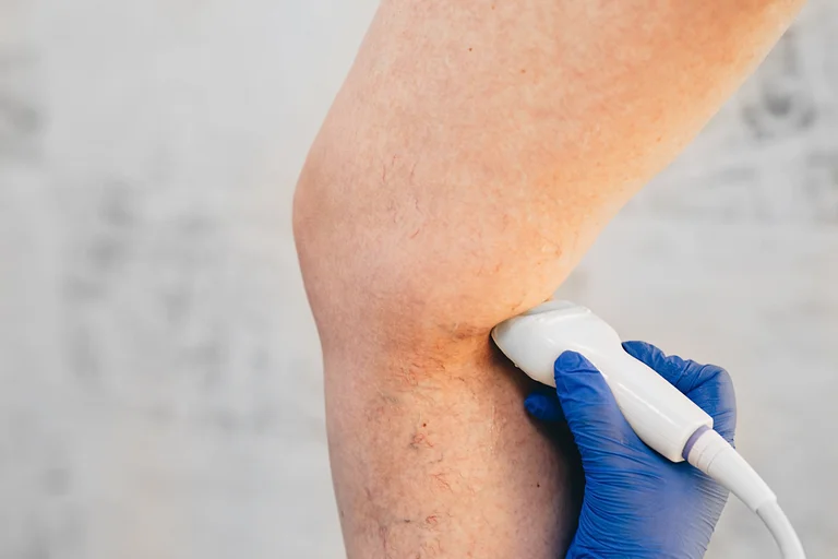 Ultraschalluntersuchung am Bein, um Krampfadern zu diagnostizieren.