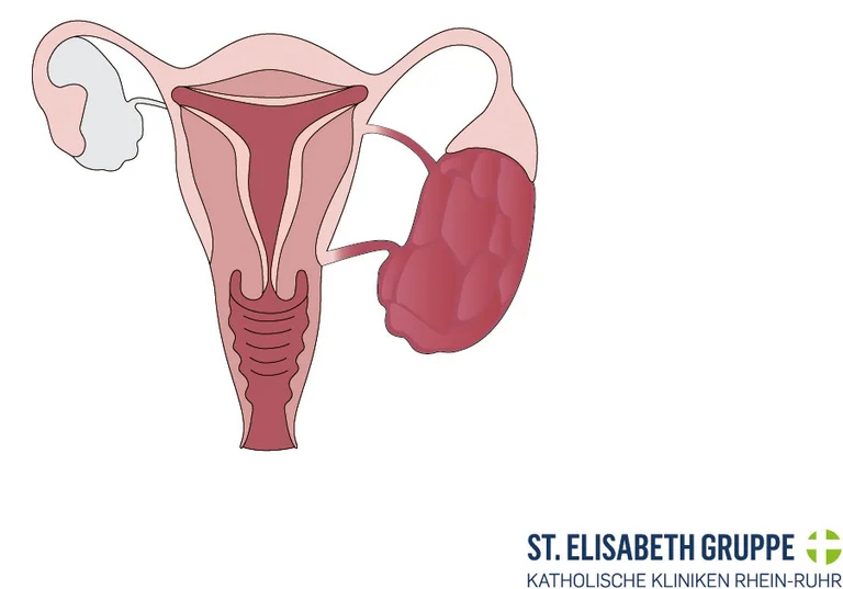 Eierstockkrebs (Ovarialkarzinom) ist die zweithäufigste bösartige Erkrankung der weiblichen Geschlechtsorgane.