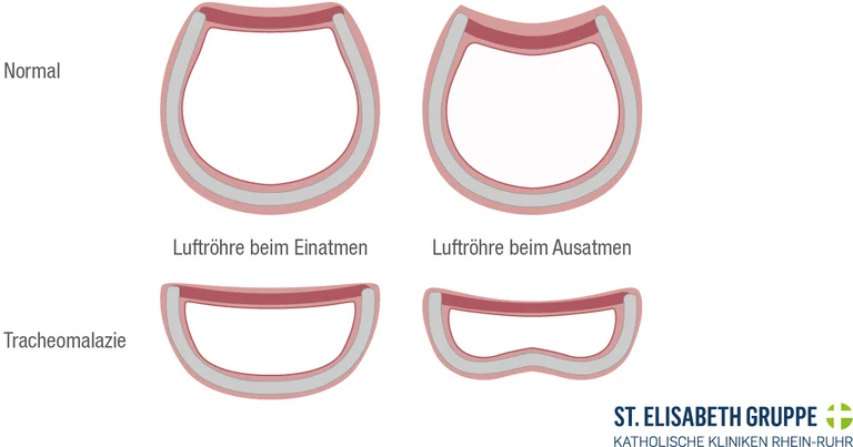 Grafische Darstellung einer gesunden Luftröhre sowie einer Luftröhre mit Tracheomalazie