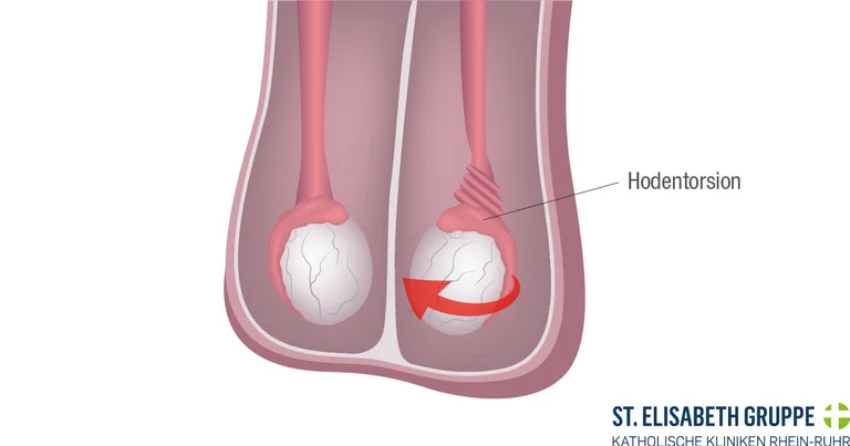 Hodentorsion