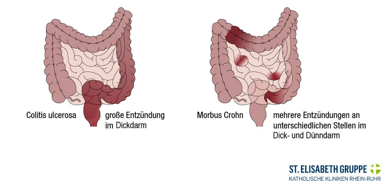 Zwischen den chronisch-entzündlichen Darmerkrankungen Morbus Crohn und Colitis ulcerosa gibt es Unterschiede.