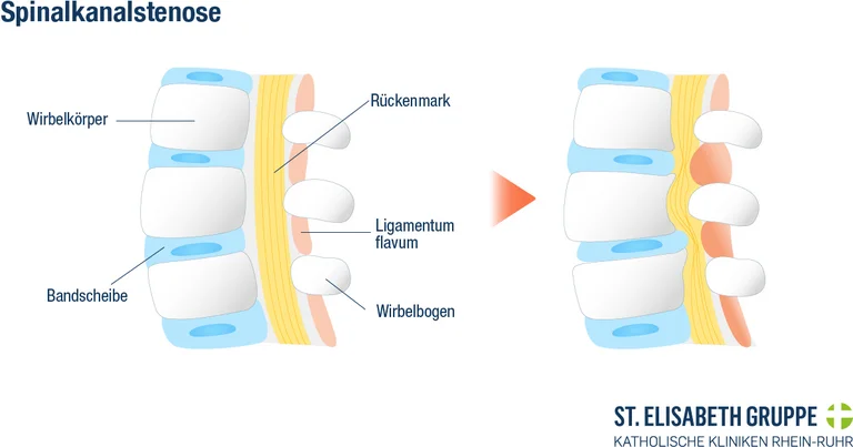 Gesunde Wirbelsäule vs. Spinalkanalstenose