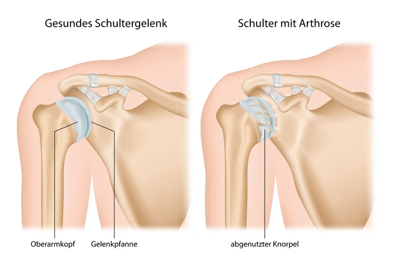 Gesundes Schultergelenk im Vergleich zu einer Schulter mit Omarthrose