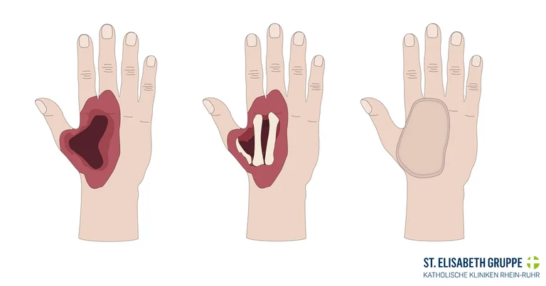 Beispiel für eine Infektion an der Hand, bei der nekrotisierenden Fasziitis ist eine sofortige Behandlung notwendig.