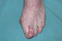 Hallux valgus