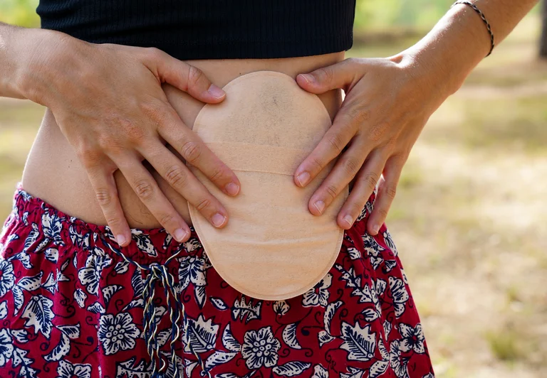 In einigen Fällen ist nach der Darmkrebs-OP ein Stoma (künstlicher Darmausgang) notwendig.