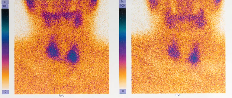 Nuklearmedizin: Szintigraphie einer Schilddrüse