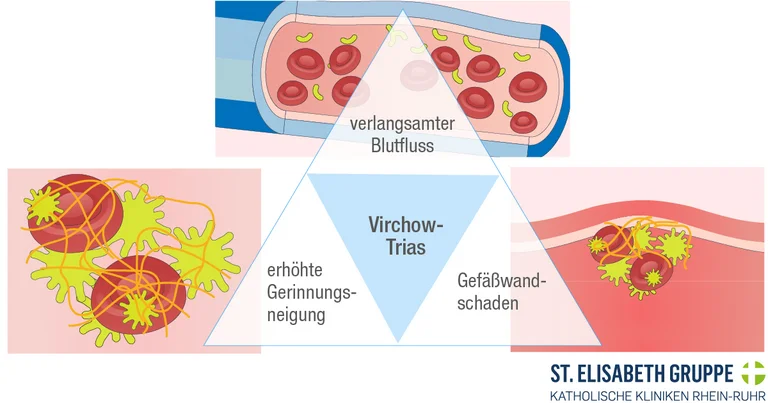 Die verschiedenen Faktoren der Virchowsche Trias