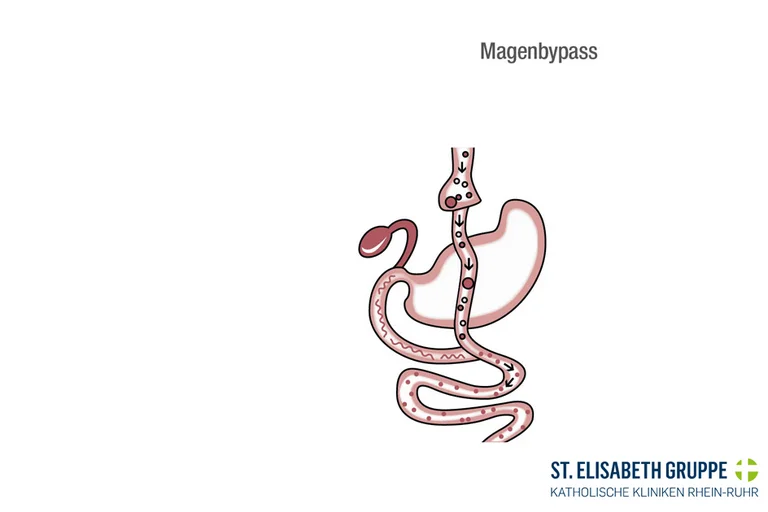 Magenbypass: Bei einem Magenbypass bei Adipositas wird eine Direktverbindung vom Magen zum Dünndarm hergestellt.