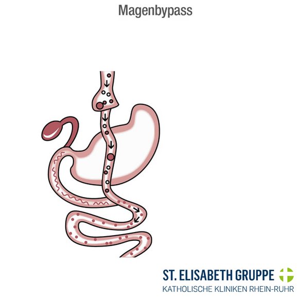 Magenbypass: Bei einem Magenbypass bei Adipositas wird eine Direktverbindung vom Magen zum Dünndarm hergestellt.
