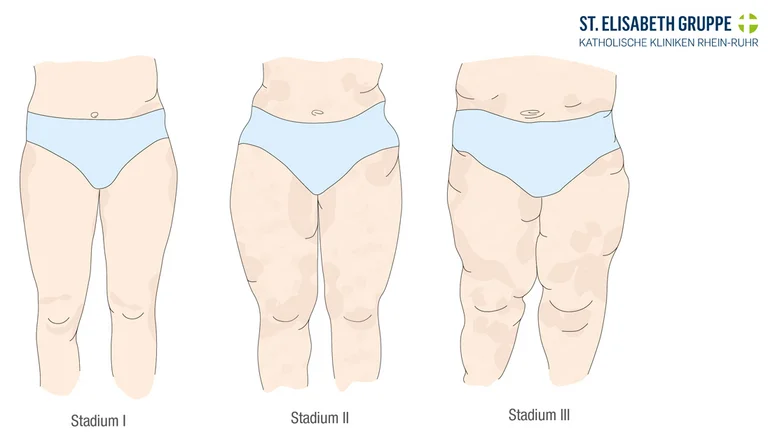 Die drei Stadien eines Lipödem