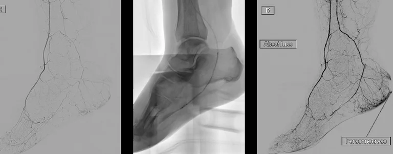 Angiografie