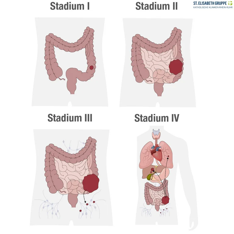 Mit dem Krankheitsstadium (Stadium I, II, III oder IV) kann die Ausbreitung von Darmkrebs beschrieben werden.