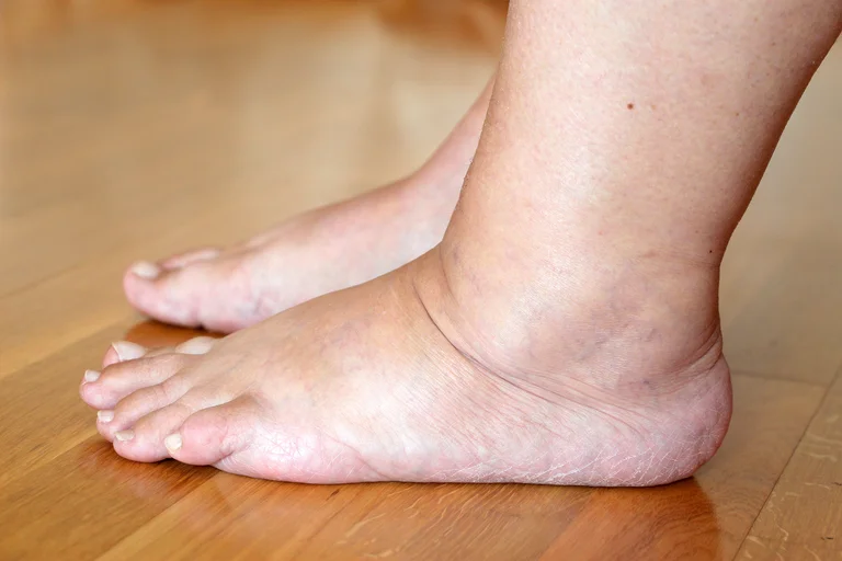 geschwollene Füße als Symptom für eine Herzinsuffizienz