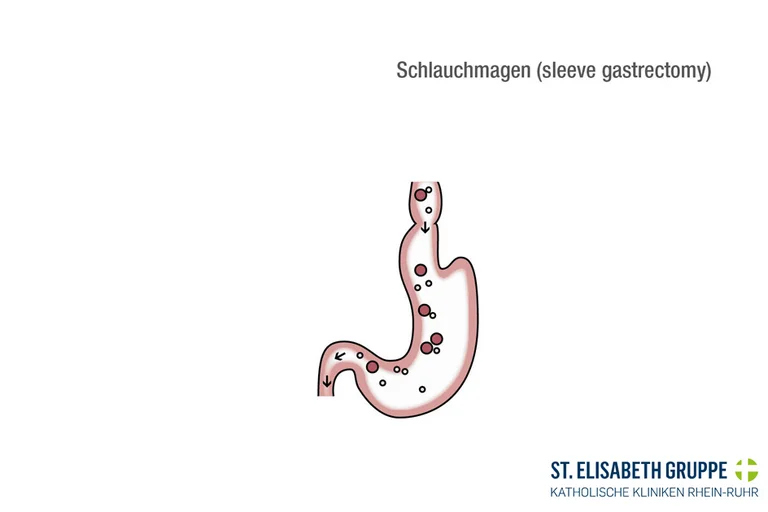 Schlauchmagen: Nach einer Schlauchmagen-Operation bei Adipositas ist der Magen schmaler. 