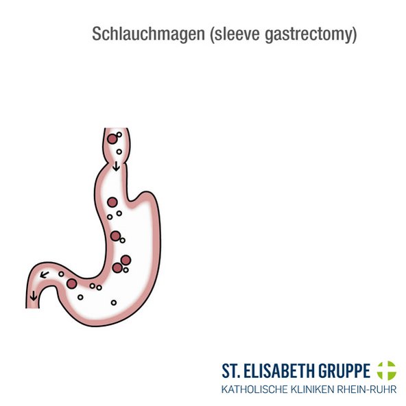 Schlauchmagen: Nach einer Schlauchmagen-Operation bei Adipositas ist der Magen schmaler. 