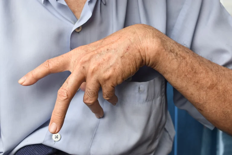 Mann mit Dupuytren in der linken Hand