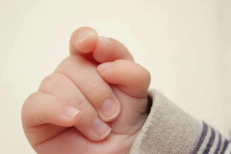 Hexadaktylie ist eine angeborene Fehlbildung, bei der Menschen sechs Finger an einer Hand oder sechs Zehen an einem Fuß haben.