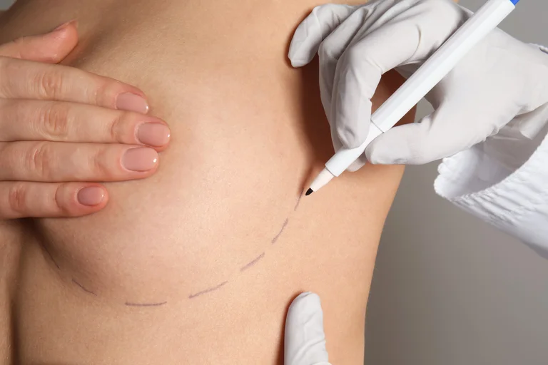 Arzt zeichnet bei einer Patientin Linien für eine Brustoperation an