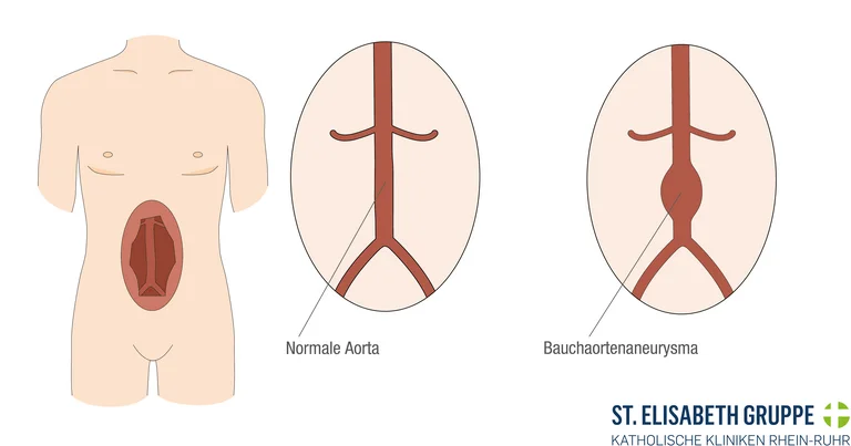 Grafische Darstellung einer normalen Aorta (links) und eines Bauchaortenaneurysmas (rechts), das eine vergrößerte und ausgedehnte Bauchschlagader zeigt.